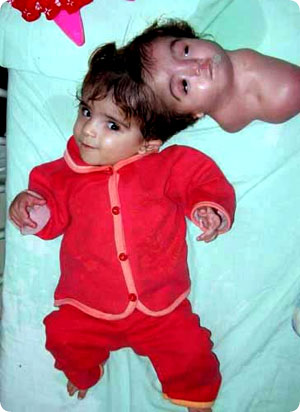閲覧注意 双子の片割れと頭を共有している奇形児が可愛いけどやっぱり怖い カルロ グローチェ