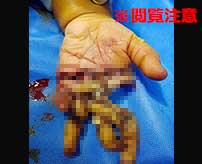 フィリピンの肉挽き工場で起きてしまった悲惨な事故の画像。 親と一緒に工場に訪れていたまだ幼い子供が、目を離した隙に肉挽き機の中に手を突っ込んでしまう… すぐに病院に搬送されましたが子供の指はグッチャグチャに切り裂かれていて、 最終的に親指と小指以外の3本の指を切断してしまう結果となってしまいました…(´・ω・`)