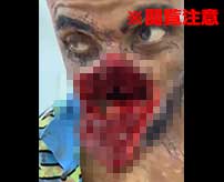 【閲覧注意】顔面を切り裂かれた男、鼻から下がベロッと捲れて丸見えに…