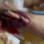 【閲覧注意】地雷を踏んだロシア兵の足、骨が見えちゃってる…