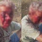 バイク事故によって男の顔面が…鼻がほとんど終わる